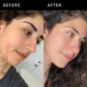 inkey-list-succinic-acid-acne-treatment-ink-ess-0010-empress-origin-01